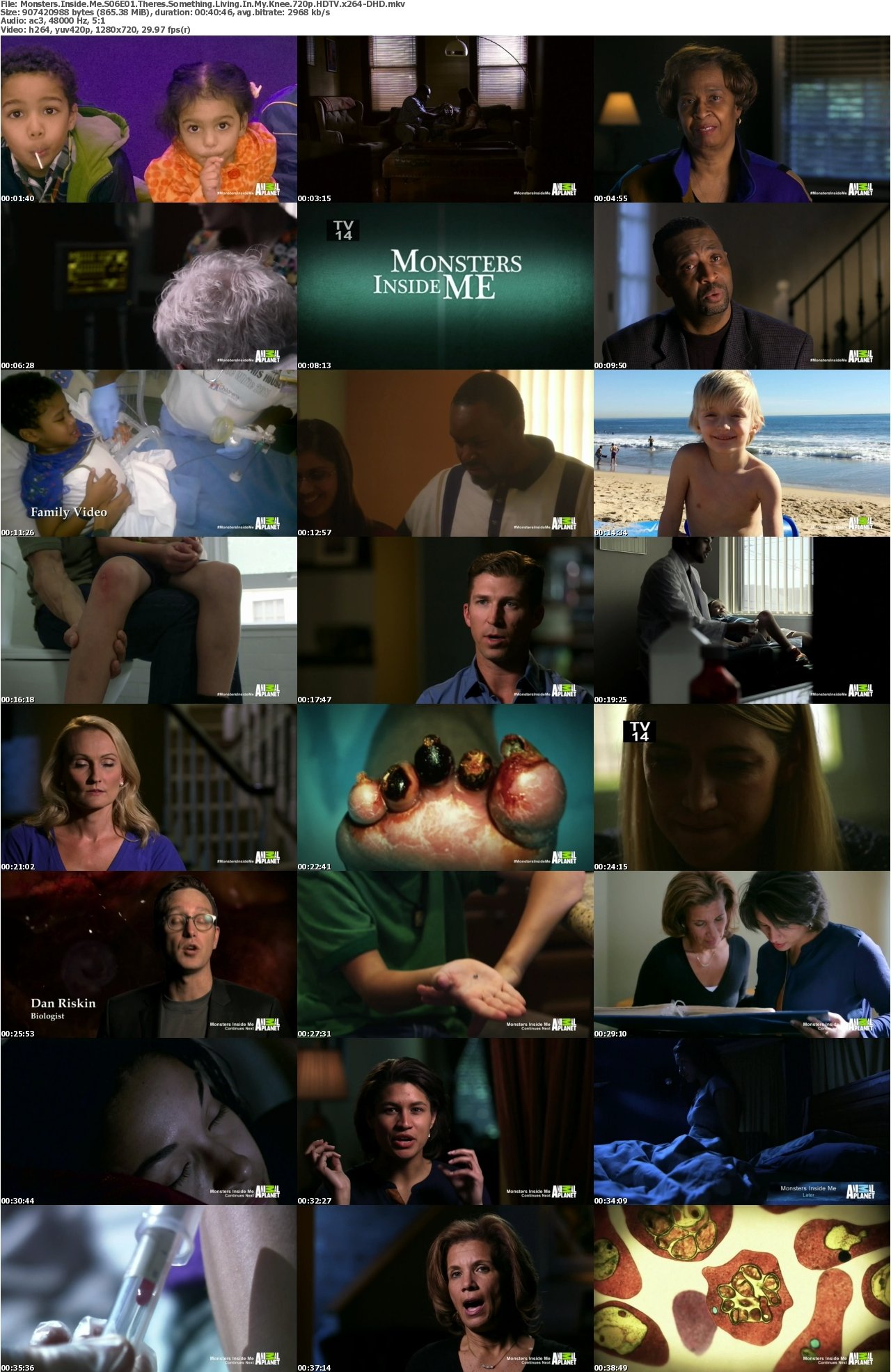 Monsters Inside Me S06E01 Theres Something Living In My Knee 720p HDTV x264-DHD