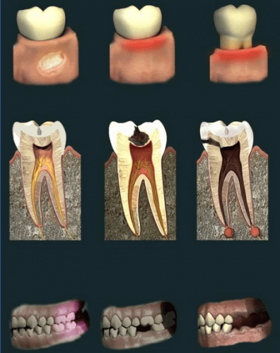 Dental Pain v1.01 build 2 Paid