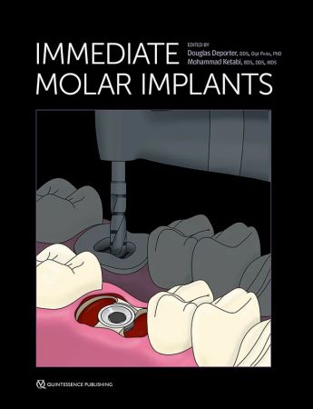 Immediate Molar Implants 1st Edition