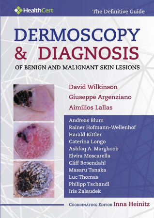 Dermoscopy &amp; Diagnosis of Benign and Malignant Skin Lesions
