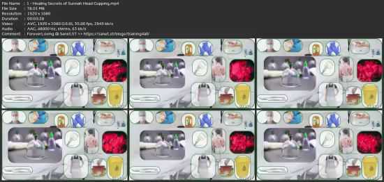Head Hijama Advanced Sunnah Wet Cupping Technique With Honey