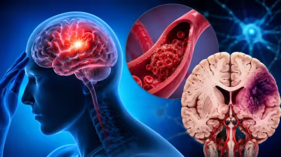 Stroke Made Simple