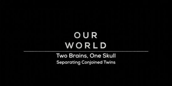 BBC Our World - Two Brains, One Skull - Separating Conjoined Twins (2019) 720p HDTV x264 AAC MVGroup