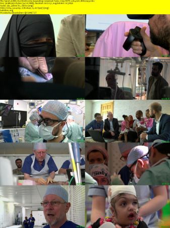 BBC Our World - Two Brains, One Skull - Separating Conjoined Twins (2019) 720p HDTV x264 AAC MVGroup