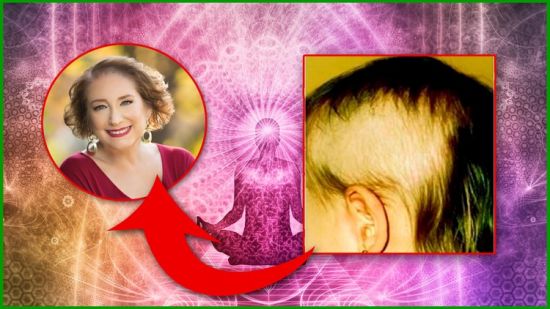 EFT Your Trichotillomania