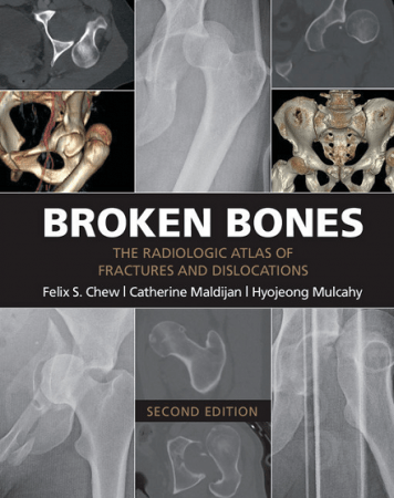 Broken Bones: The Radiologic Atlas of Fractures and Dislocations, 2nd Edition