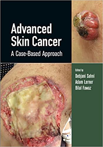 Advanced Skin Cancer A Case-based Approach 1st Edition