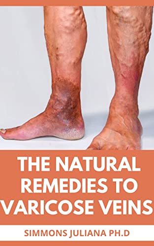 The Natural Remedies To Varicose Veins